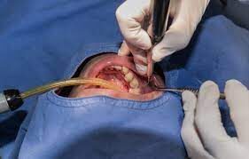 Post Graduate Diploma In Oral  Surgery